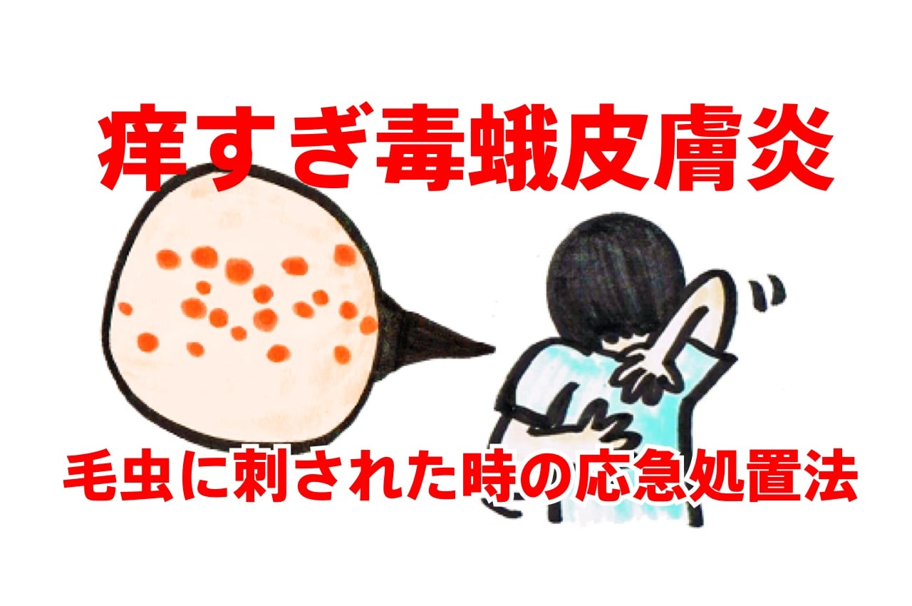 毛虫に刺された 激しい痒み 毒蛾皮膚炎の症状と市販薬での応急処置 毛虫画像なし 虫無理ドットコム